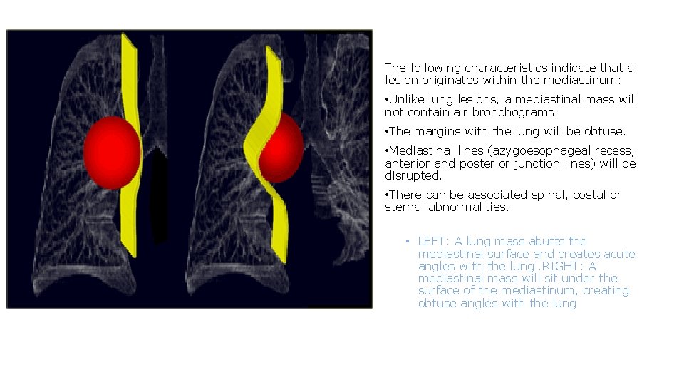 The following characteristics indicate that a lesion originates within the mediastinum: • Unlike lung