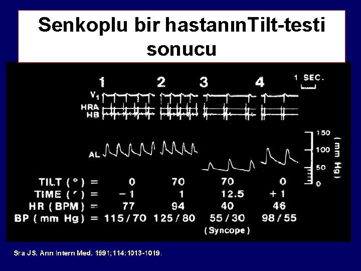 Senkoplu bir hastanın. Tilt-testi sonucu 