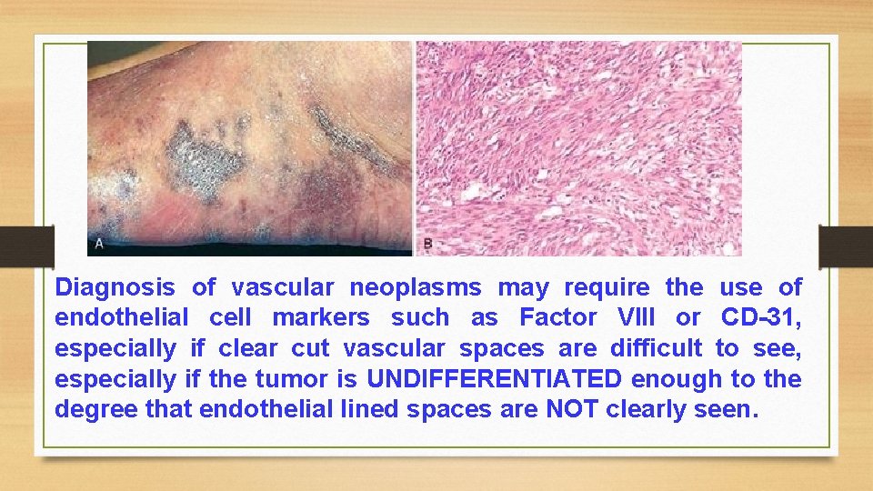 Diagnosis of vascular neoplasms may require the use of endothelial cell markers such as