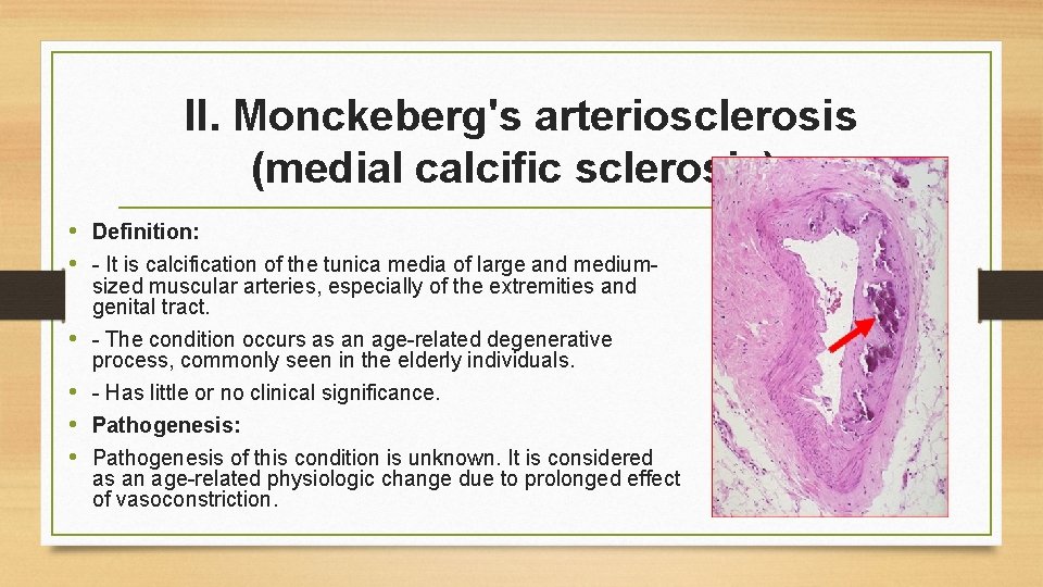 II. Monckeberg's arteriosclerosis (medial calcific sclerosis): • Definition: • - It is calcification of