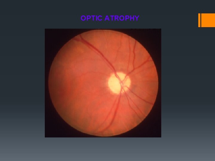 OPTIC ATROPHY 