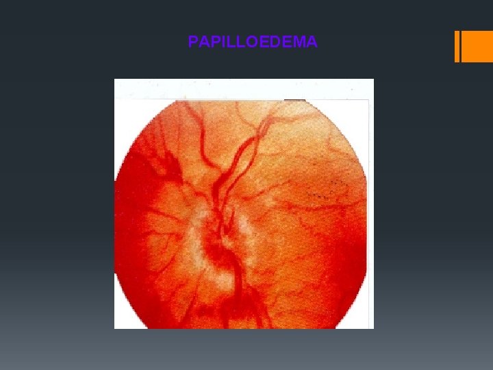 PAPILLOEDEMA 
