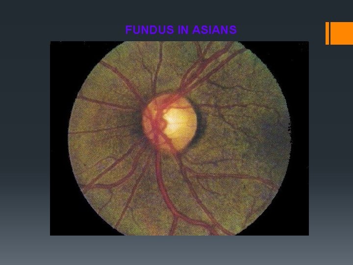 FUNDUS IN ASIANS 