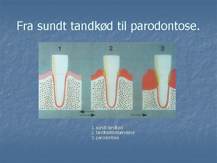 Fra sundt tandkød til parodontose. 1. sundt tandkød 2. tandkødsbetændelse 3. parodontose 