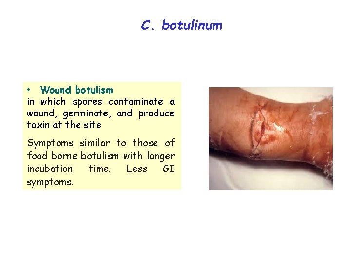 C. botulinum • Wound botulism in which spores contaminate a wound, germinate, and produce