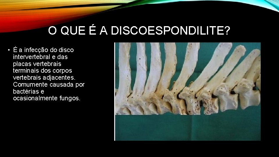 O QUE É A DISCOESPONDILITE? • É a infecção do disco intervertebral e das