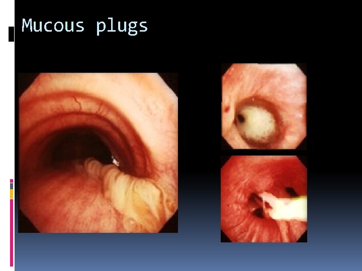 Mucous plugs 