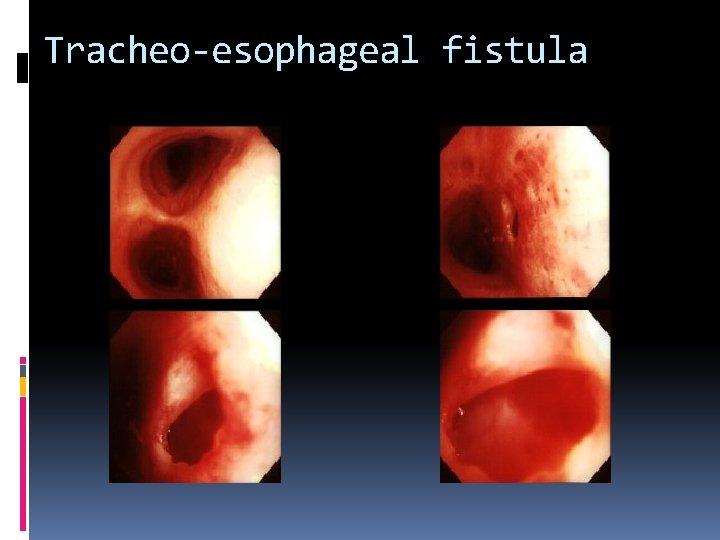 Tracheo-esophageal fistula 