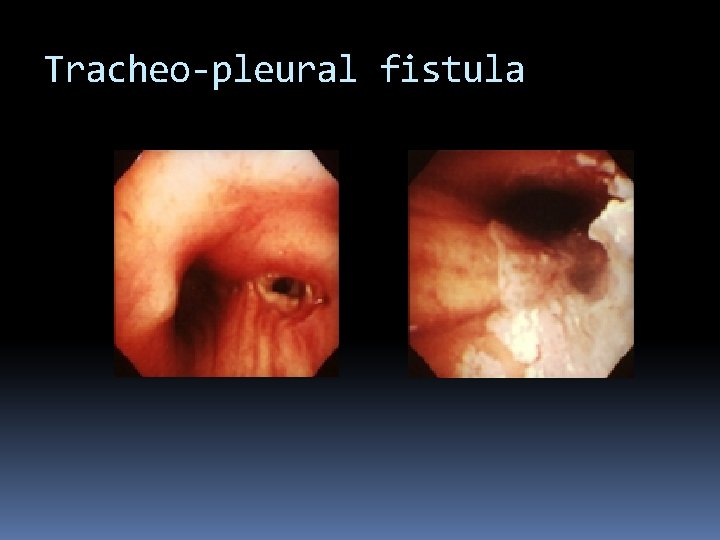 Tracheo-pleural fistula 