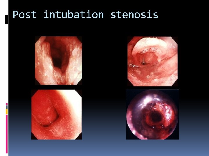 Post intubation stenosis 