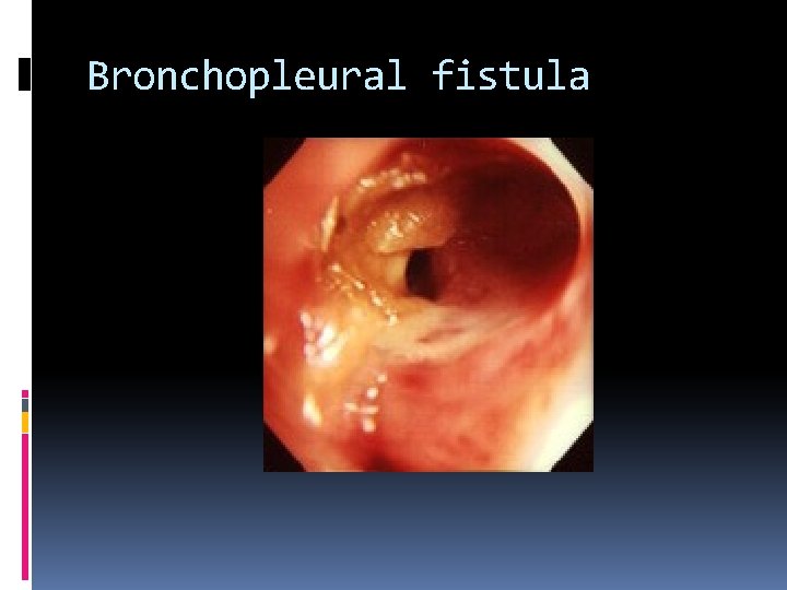 Bronchopleural fistula 