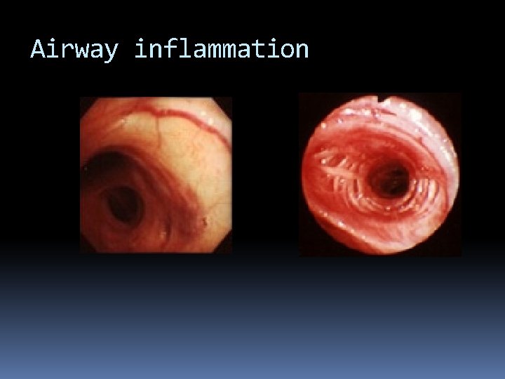 Airway inflammation 