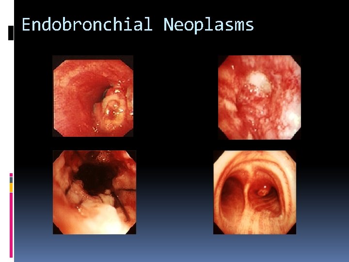 Endobronchial Neoplasms 