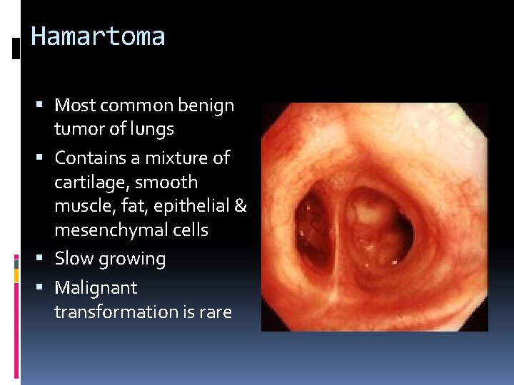 Hamartoma Most common benign tumor of lungs Contains a mixture of cartilage, smooth muscle,