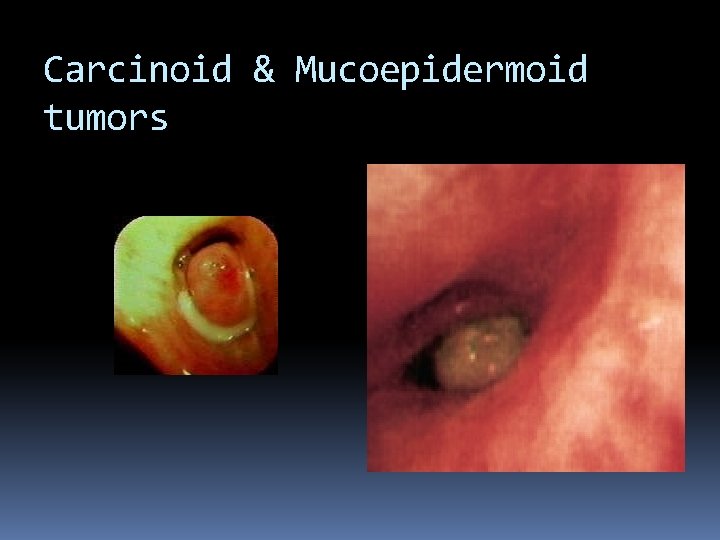 Carcinoid & Mucoepidermoid tumors 