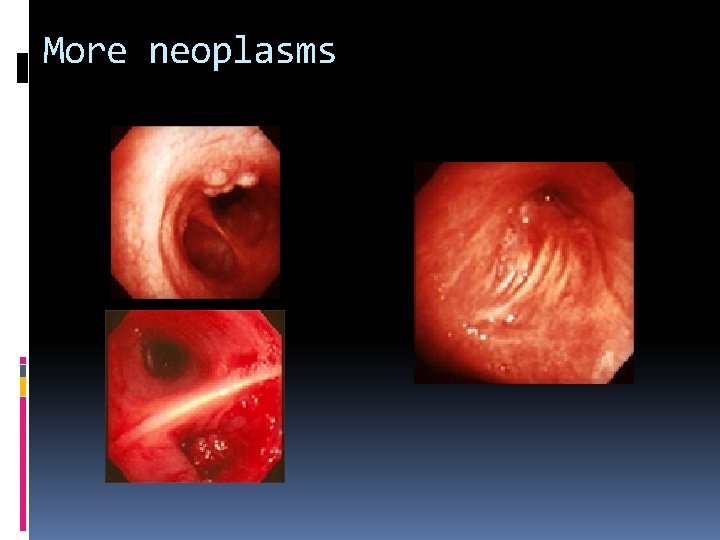 More neoplasms 