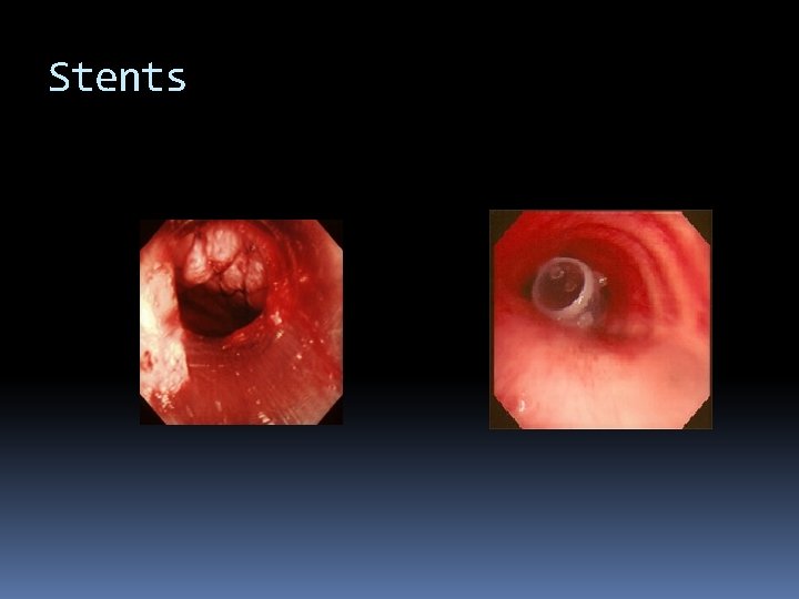 Stents 