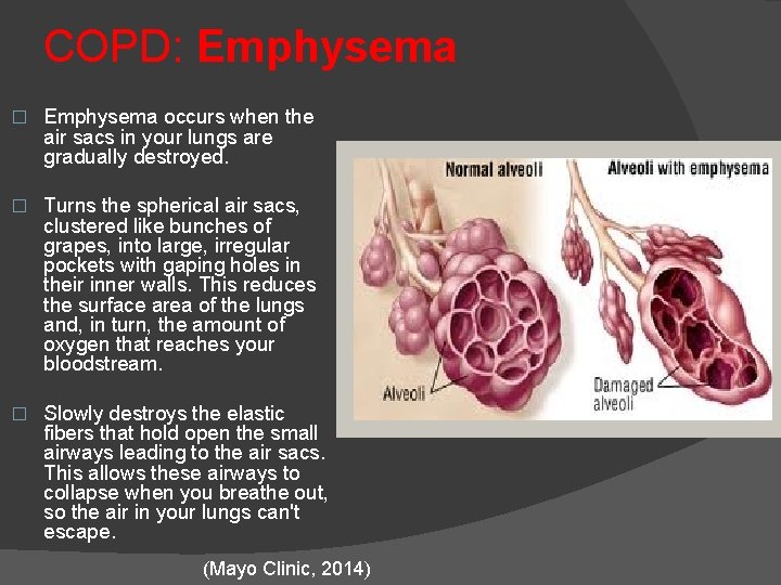 COPD: Emphysema � Emphysema occurs when the air sacs in your lungs are gradually