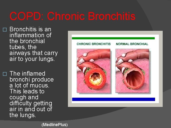 COPD: Chronic Bronchitis � Bronchitis is an inflammation of the bronchial tubes, the airways