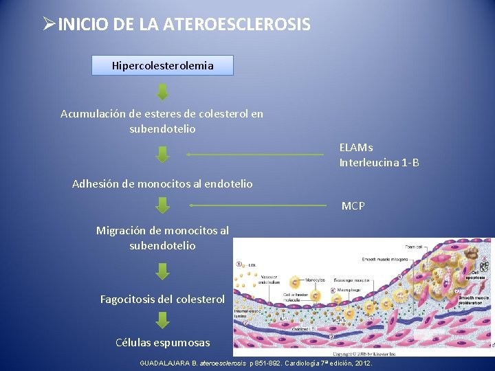 ØINICIO DE LA ATEROESCLEROSIS Hipercolesterolemia Acumulación de esteres de colesterol en subendotelio ELAMs Interleucina