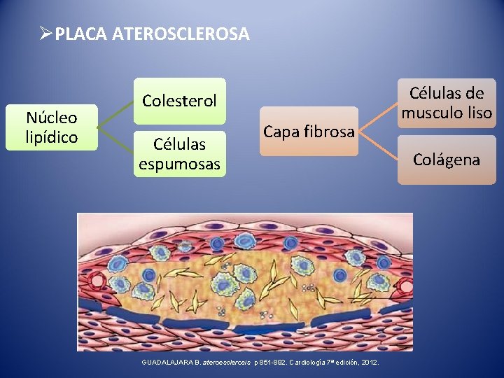 ØPLACA ATEROSCLEROSA Núcleo lipídico Colesterol Células espumosas Capa fibrosa GUADALAJARA B. ateroesclerosis p 851