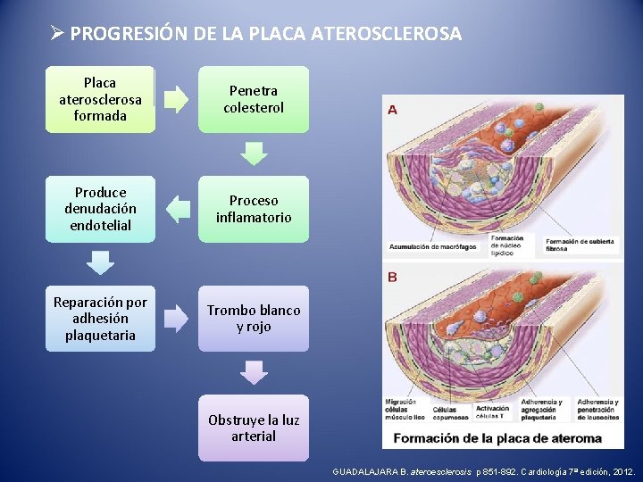 Ø PROGRESIÓN DE LA PLACA ATEROSCLEROSA Placa aterosclerosa formada Penetra colesterol Produce denudación endotelial