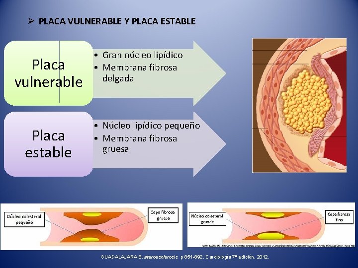 Ø PLACA VULNERABLE Y PLACA ESTABLE Placa vulnerable Placa estable • Gran núcleo lipídico