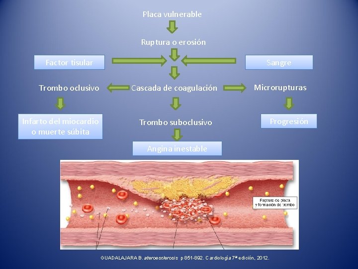 Placa vulnerable Ruptura o erosión Factor tisular Trombo oclusivo Infarto del miocardio o muerte