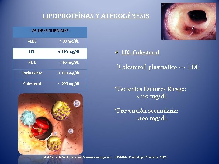 LIPOPROTEÍNAS Y ATEROGÉNESIS VALORES NORMALES VLDL < 30 mg/d. L LDL < 130 mg/d.