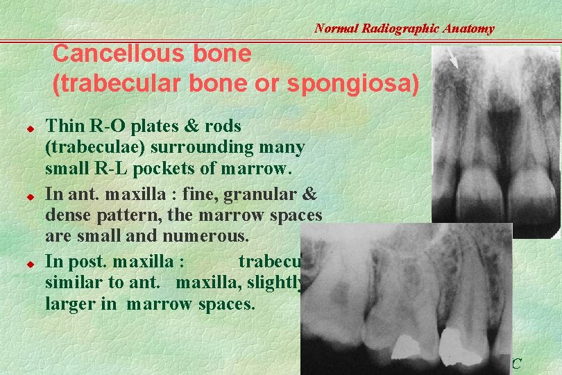 Normal Radiographic Anatomy Cancellous bone (trabecular bone or spongiosa) u u u Thin R-O
