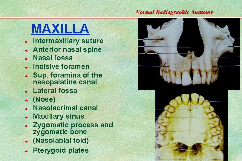Normal Radiographic Anatomy MAXILLA u u u Intermaxillary suture Anterior nasal spine Nasal fossa