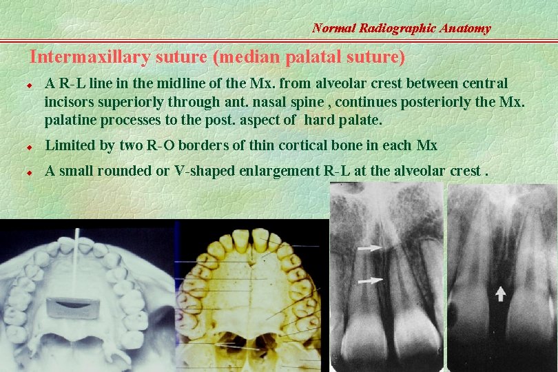 Normal Radiographic Anatomy Intermaxillary suture (median palatal suture) u A R-L line in the