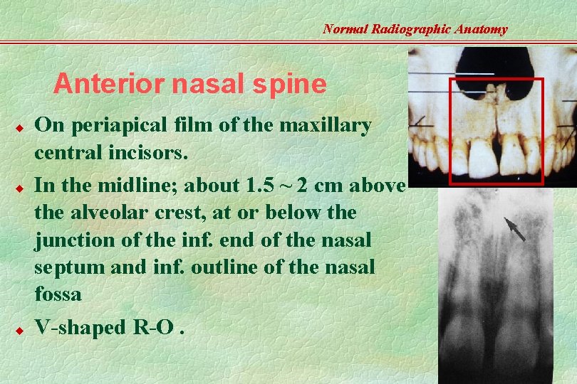 Normal Radiographic Anatomy Anterior nasal spine u u u On periapical film of the