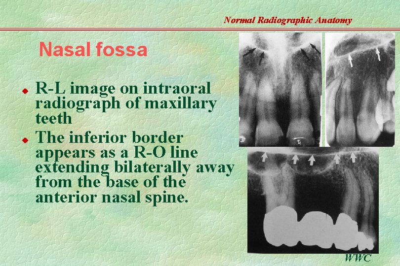 Normal Radiographic Anatomy Nasal fossa u u R-L image on intraoral radiograph of maxillary