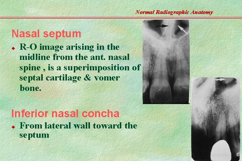 Normal Radiographic Anatomy Nasal septum u R-O image arising in the midline from the