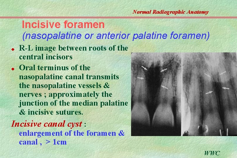 Normal Radiographic Anatomy Incisive foramen (nasopalatine or anterior palatine foramen) R-L image between roots