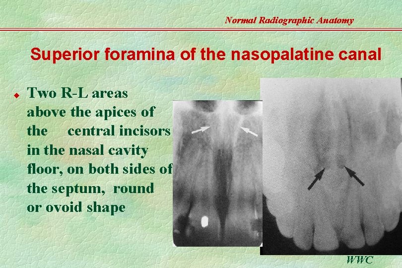 Normal Radiographic Anatomy Superior foramina of the nasopalatine canal u Two R-L areas above