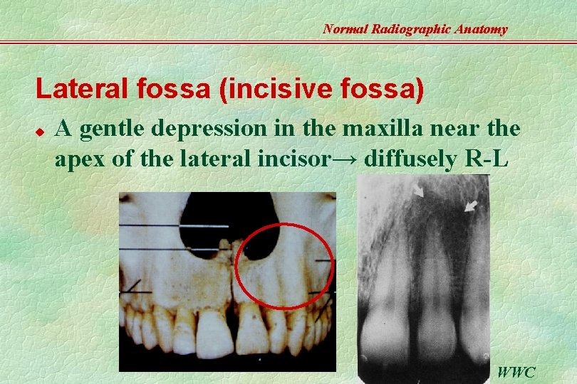 Normal Radiographic Anatomy Lateral fossa (incisive fossa) u A gentle depression in the maxilla