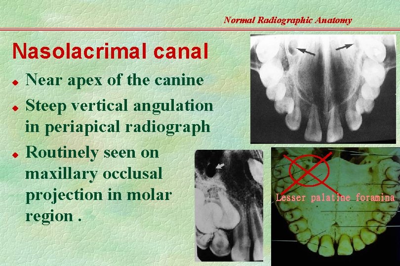 Normal Radiographic Anatomy Nasolacrimal canal u u u Near apex of the canine Steep