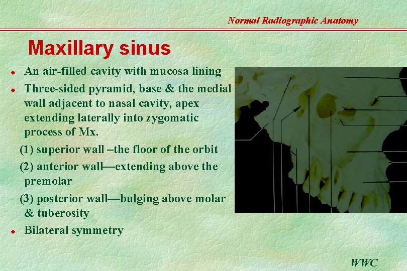 Normal Radiographic Anatomy Maxillary sinus u u u An air-filled cavity with mucosa lining