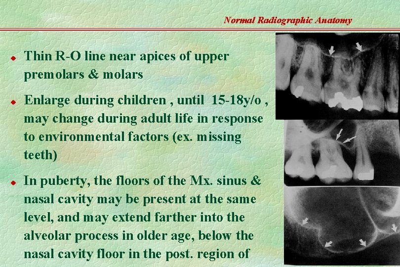 Normal Radiographic Anatomy u u u Thin R-O line near apices of upper premolars