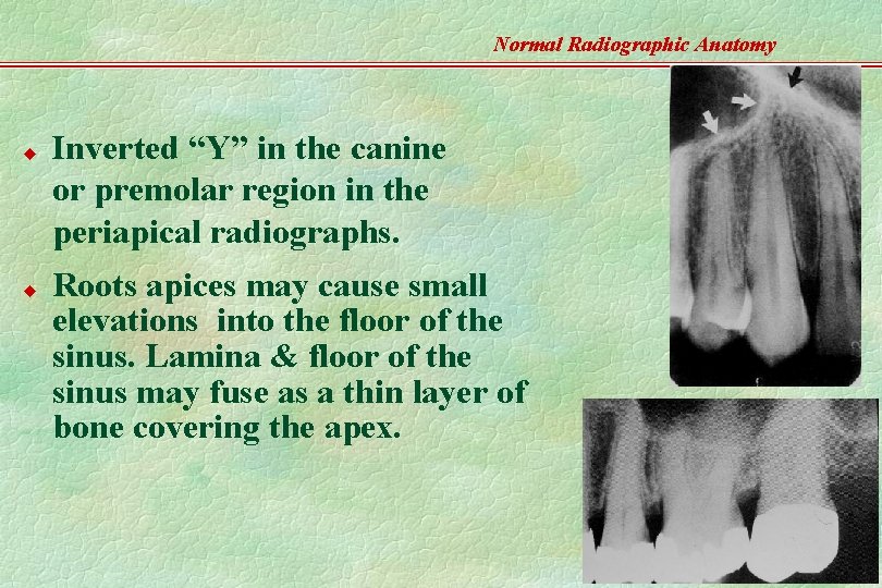 Normal Radiographic Anatomy u u Inverted “Y” in the canine or premolar region in