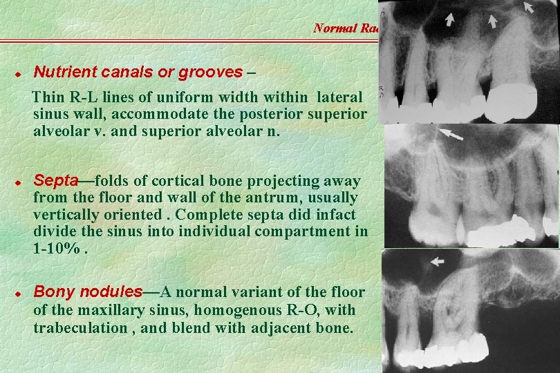 Normal Radiographic Anatomy u u u Nutrient canals or grooves – Thin R-L lines