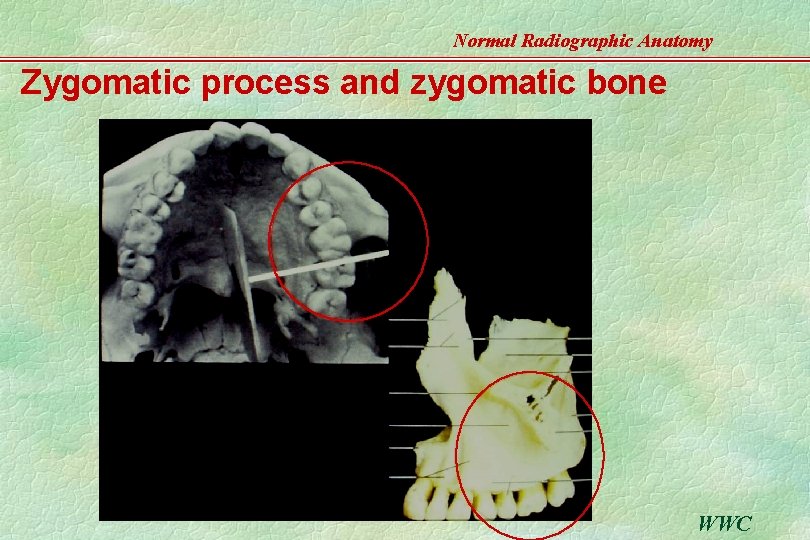 Normal Radiographic Anatomy Zygomatic process and zygomatic bone WWC 