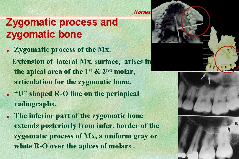Normal Radiographic Anatomy Zygomatic process and zygomatic bone u Zygomatic process of the Mx:
