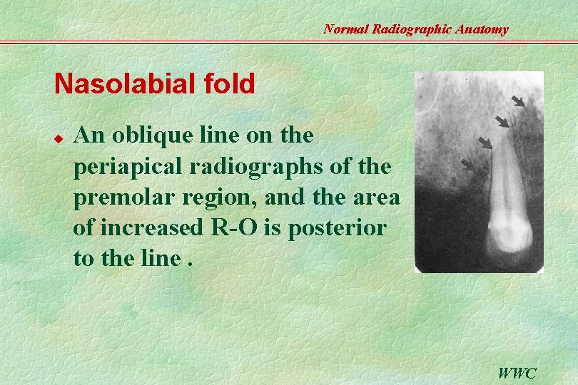 Normal Radiographic Anatomy Nasolabial fold u An oblique line on the periapical radiographs of