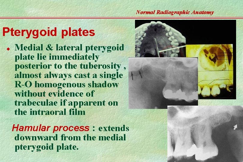 Normal Radiographic Anatomy Pterygoid plates u Medial & lateral pterygoid plate lie immediately posterior
