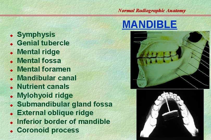 Normal Radiographic Anatomy u u u Symphysis Genial tubercle Mental ridge Mental fossa Mental