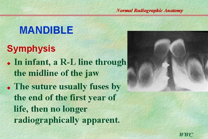 Normal Radiographic Anatomy MANDIBLE Symphysis u In infant, a R-L line through the midline