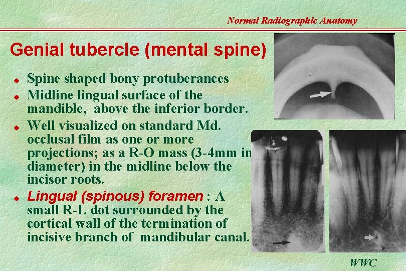 Normal Radiographic Anatomy Genial tubercle (mental spine) u u Spine shaped bony protuberances Midline